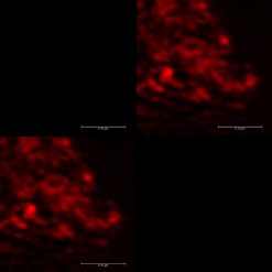 Obr. 5b: Kolokalizace nanodiamantů s navázaným fluorescein aminem (FAM) po ozáření laserovým paprskem – nahoře vlevo: luminiscence fluorescenčního barviva fluorescein aminu, nahoře vpravo: stálá luminiscence nanodiamantu, dole vlevo: sjednocení horních obrázků